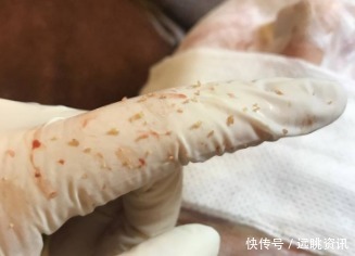 白色|下巴处冒出的白色小疙瘩,看过去连成一片,多半是因为螨虫撕咬!