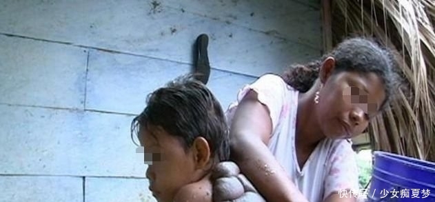 不料|男孩背后长肉瘤,后变“忍者神龟”,家人愁眉不展,不料发生奇迹