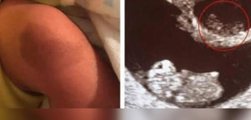 消失综合征|姐姐在腹中被弟弟“吸收”,变成胎记留弟弟腿上,网友最美胎记