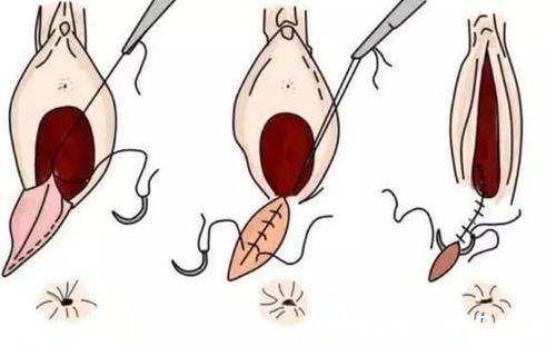 剖腹产|顺产时“侧切”或“撕裂”,能否对产妇生活造成影响?先了解一下