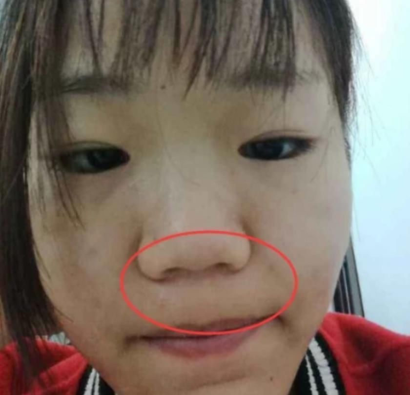 黑头粉刺|最“毁鼻子”的3行为,学生党却养成习惯,占一个异性缘归0哟!