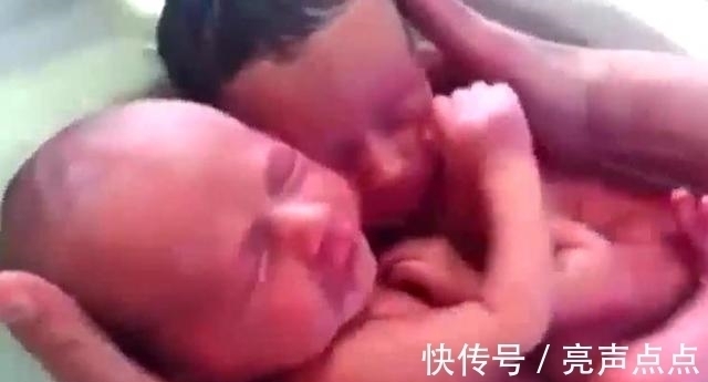 小家伙|双胞胎哥俩被剖腹抱出,哥哥以为有危险,一把将弟弟搂住!