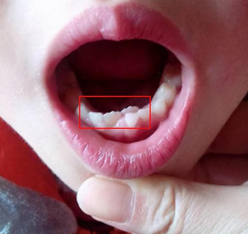 孩子|6岁男娃长“双层牙”,老人的“坏习惯”害了娃,你家有这习惯吗