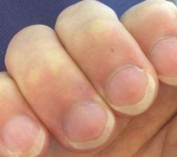 大部分|“月牙”越多，身体越好？大部分人都理解错了，看看自己属于哪种