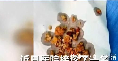 宝宝|5个月婴儿患“肾结石”,都是辅食惹的祸,医生:很多家庭还在喂