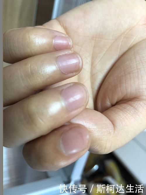 月牙|指甲是人体健康的“晴雨表”,若有这3个表现,或与健康密切相关