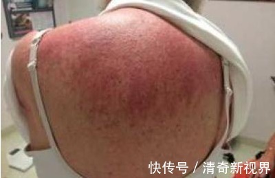 皮肤|肺癌来袭,皮肤先知!医生教你如何通过看皮肤,判断患有肺癌