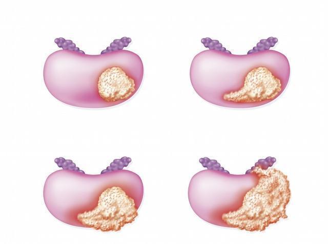 体检查出结节、息肉、增生、囊肿，哪个是癌症