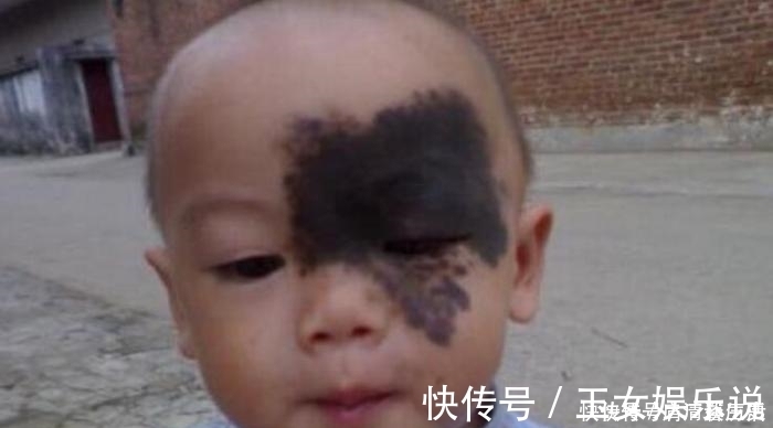 油炸食物|宝宝出生后身上出现大片红疹和胎记,都是孕妇不忌口吃了这些东西