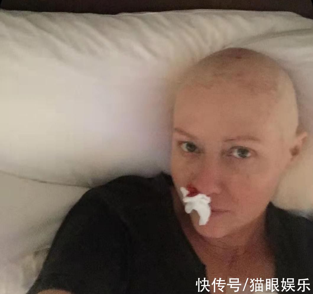 希德姐妹帮|50岁女星乳腺癌复发!头发全被剃光鼻血流不停,确诊晚期仍乐观