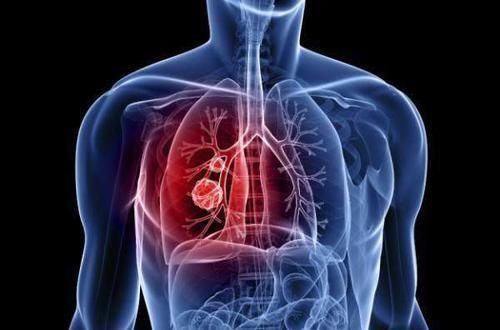 去世|55岁男子,体检正常5个月后查出晚期肺癌去世体检到底有何用