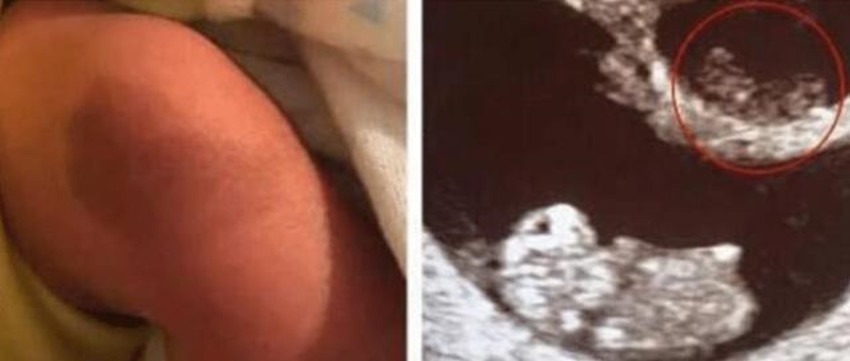 孕妈|姐姐在腹中被弟弟“吸收”,变成胎记留弟弟腿上,网友最美胎记