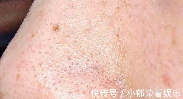 洗面奶|刚打湿脸就涂洗面奶,难怪黑头越长越多,告诉你正确的洗脸方法