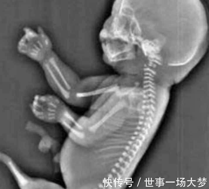 童话故事|还记得那位患“美人鱼病”的人吗?她后来怎么样了?