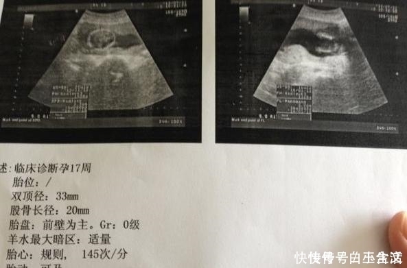 妈妈们|B超单上若有这五个字,孕妈就乐吧,可能是“小淘气”来敲门了