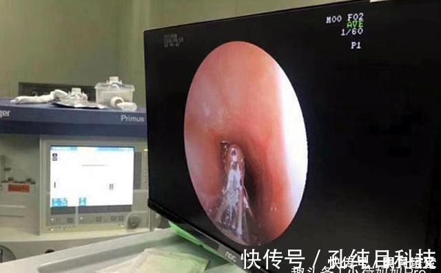 作业|孩子写作业时突然肚子疼,送去医院后,却在其体内发现一团“胶”