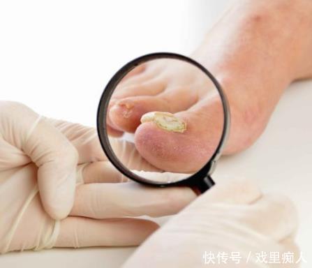 纹路|肝病被称为“冷漠杀手”,脚部出现4种不良表现,肝多半出问题了