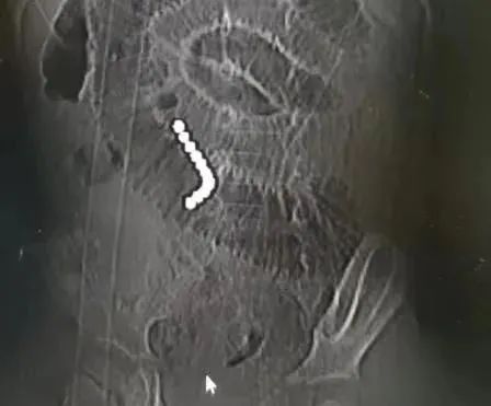 珠江医院|家长注意!三岁男童误吞“夺命玩具”致严重肠穿孔