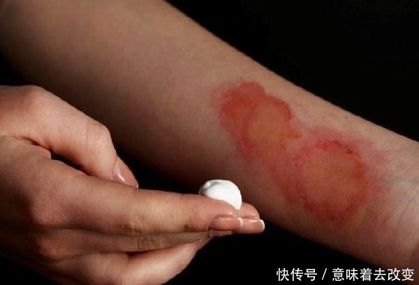 红药水|6岁儿子被100度开水烫伤,宝妈“2招”救了娃,医生:很优秀