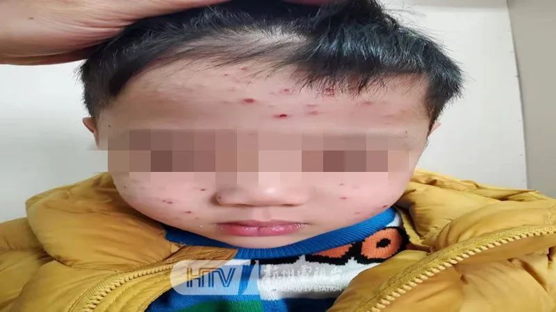 杭州市第一人民医院|杭州4岁男孩冻得满脸红疹，不是冻疮……这种病，这些人留意→