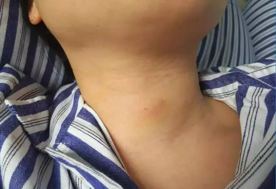 甲状腺激素|女网红直播时晕倒，确诊甲状腺癌，医生：3物经常吃，甲状腺或“烂如渔网”