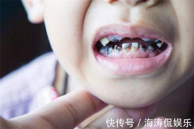 女儿|家里这3种东西,比糖更易让孩子长出“黑牙”,家长应该了解