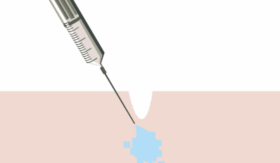 分子|济南海峡整形分享：注射玻尿酸和水光里的玻尿酸有什么区别？