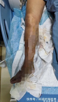 保命|浙江阿姨海边玩一下午,几天后要靠截肢保命!医生:十多年没碰到过,这类人群格外当心