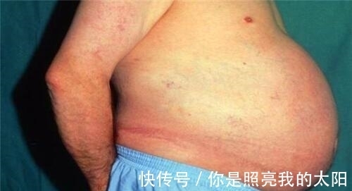 约翰|他是唯一被憋死的人：便秘3年没排泄，去世后尸检肠内大便重36斤