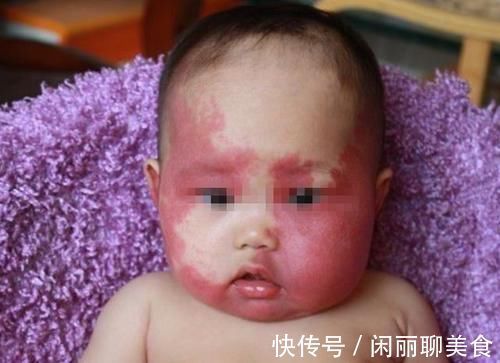 吴女士|宝宝出生自带胎记,全家乱了套,医生解释:只因妈妈没管住嘴