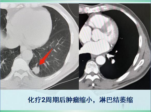 原发灶|两个肺癌病人都拖了2年才治疗,一个治愈,一个扩散了