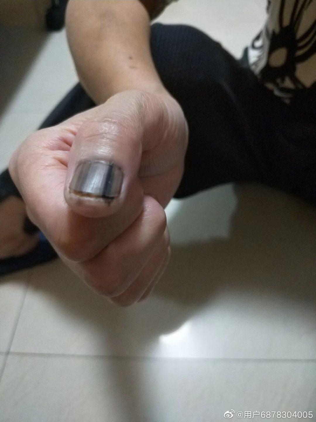 医生|指甲上有黑线,可能是最恶的癌症,医生教你怎么办