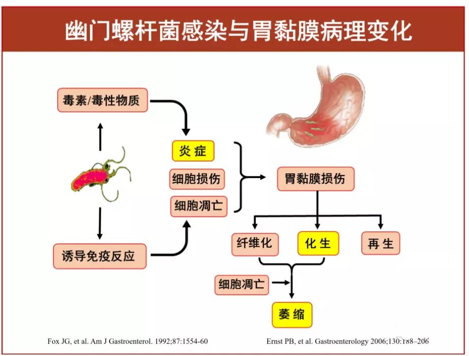 痊愈|胃病吃点药以为就痊愈了，医生从他胃部摘出个“菠萝包”，与这种菌密切相关