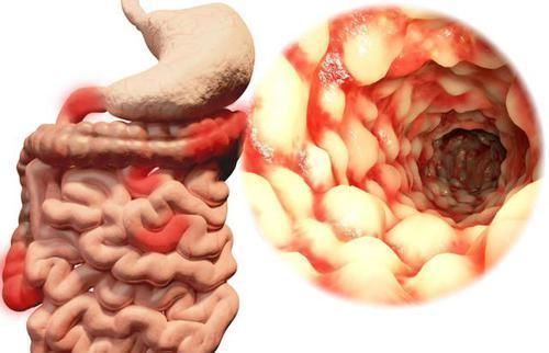 排便|排便不畅,是肠癌吗?医生:符合3个标准,尽早去医院检查一下