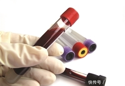 甘油三酯偏高|血脂四项中只是甘油三酯偏高，其它三项正常，这说明了什么问题？
