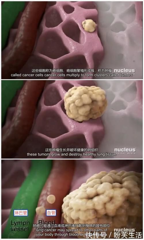 戒烟|肺癌的10大早期症状！早发现，九成可治好