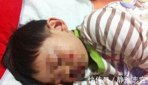 鼻血|3岁男孩摔倒流鼻血，宝妈错误的处理后，医生也“无力回天”