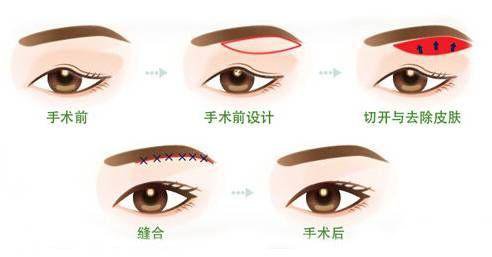 整形|济南海峡整形分享：暑假为什么越来越的人选择做双眼皮？