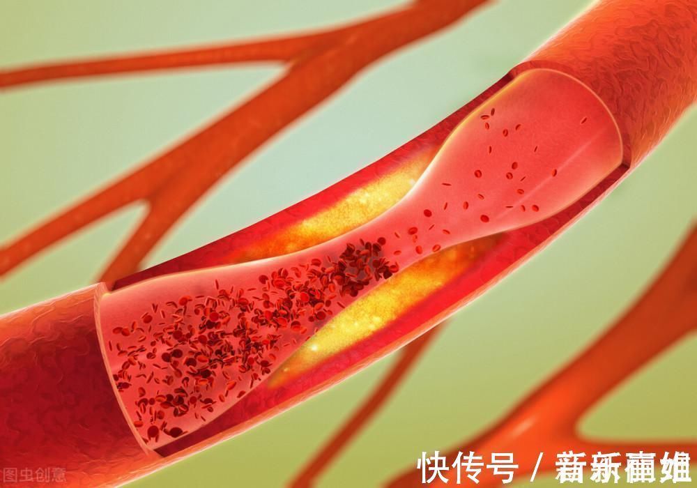 骨髓|高血脂的人,最好别碰这3种食物,多吃一口,血脂都上升,别不当回事