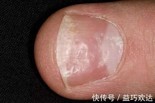 头晕头痛|血管堵,手先知,手上若有这4种表现,可能是血管堵了