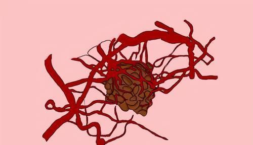 肿瘤|癌症多长时间不复发,算是治愈了?医生给出3个标准,你达标没?