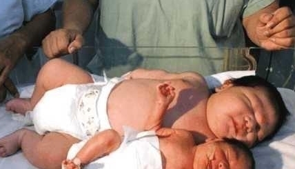 医生|700斤孕妇,以为怀的是双胞胎,分娩后人,医生瞬间傻了眼