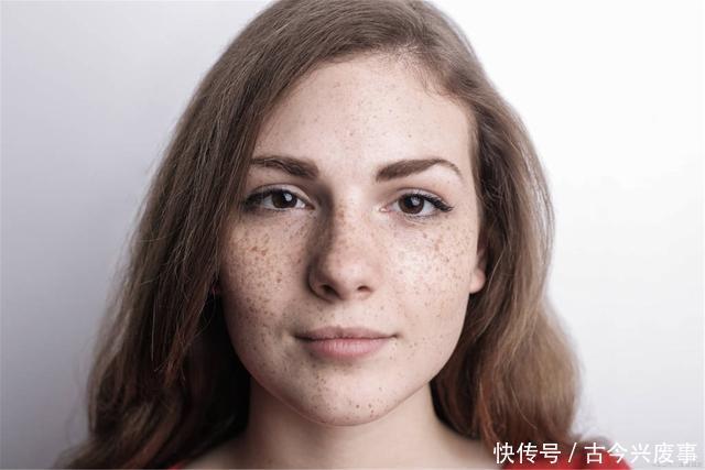 祛斑|皮秒祛斑的危害与效果