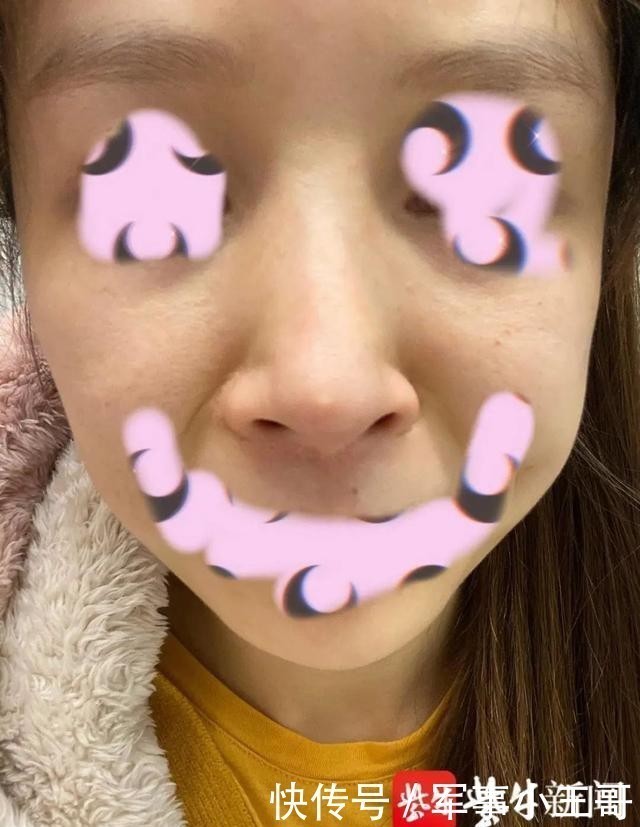 女子整容后山根晃动、鼻尖发白!手术方:很成功,已起诉