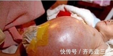 寄生胎|四岁男童肚子很大,刚开始以为是肿瘤,真相吓坏所有人!