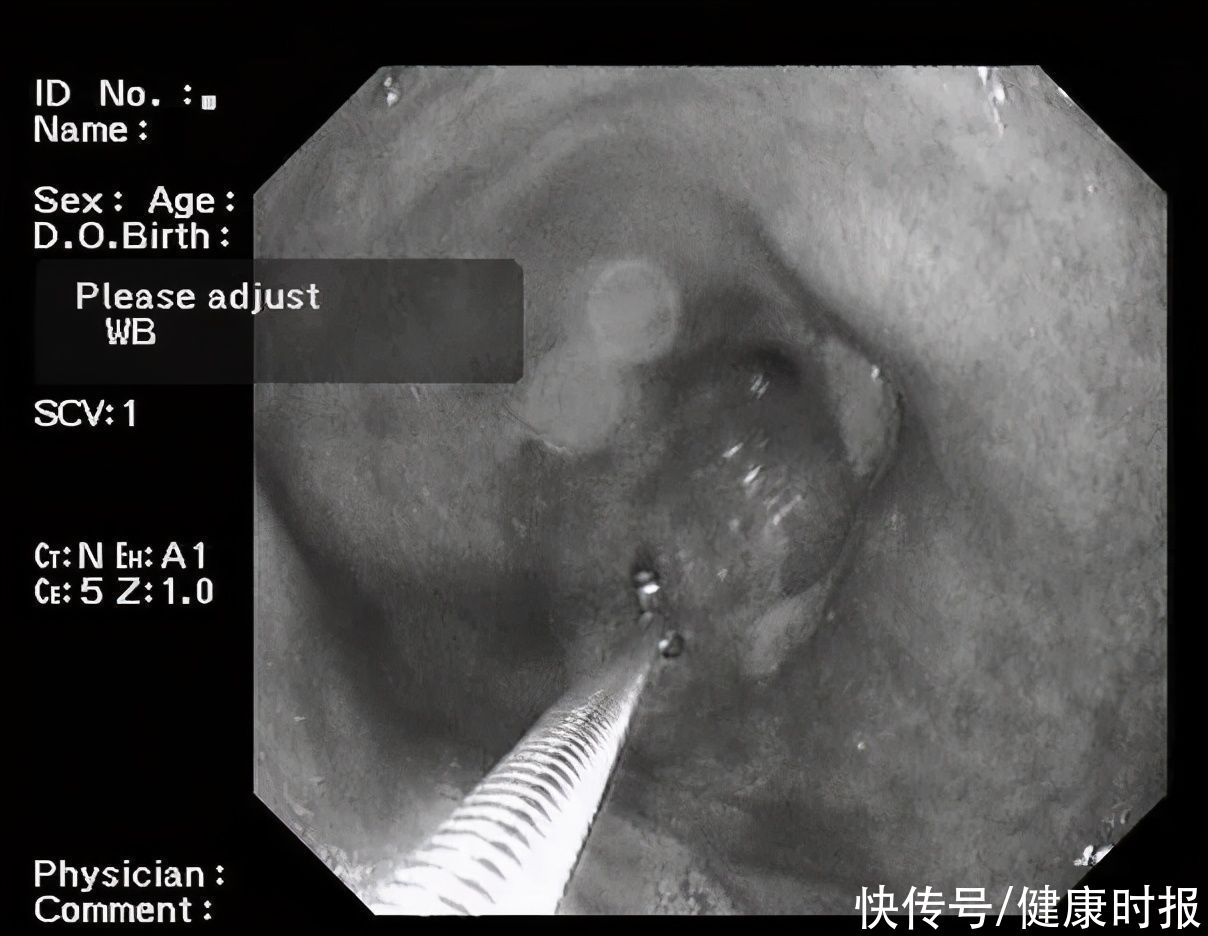 病理|为何做了三次胃镜才发现胃癌！这个病例给所有人敲响警钟