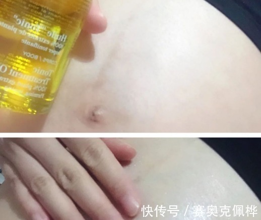 精华乳|妊娠纹只要长出来就是一辈子!拒绝“西瓜肚”辣妈分享去纹心经