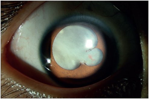 幼虫|全球首例白瞳症眼弓蛔虫病病例发现 研究团队之一来自四川农业大学