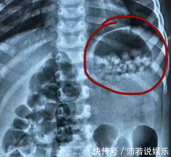 橙橙|宝宝肚子差点胀破!医生查出肚里东西,爸爸妈妈看后吓蒙!