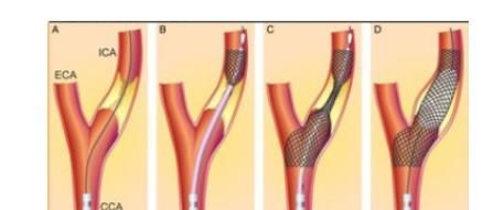 他汀|高血压合并颈动脉斑块患者，需要吃他汀和阿司匹林吗？
